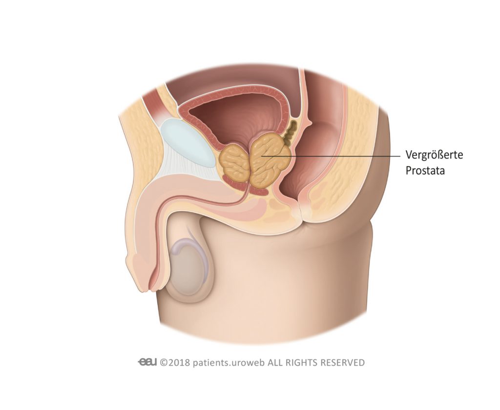 Prostata hyperplasia jelentése, Prosztata-megnagyobbodás tünetei és kezelése - HáziPatika