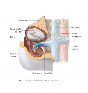Abb. 2: Tumoren im Stadium II sind ebenfalls auf die Niere beschränkt, aber größer als sieben Zentimeter.