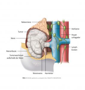 Abb. 3: Tumoren im Stadium III haben sich in die Nierenvene ausgebreitet, in das die Niere umgebende Fettgewebe (Perirenales Fett) oder in die Hohlvene.