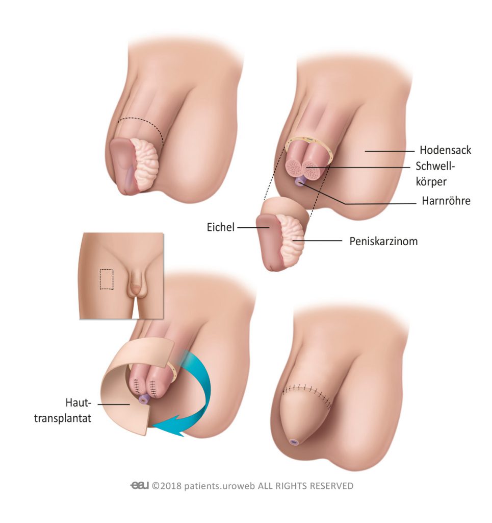 Implantat penis FTM Penile