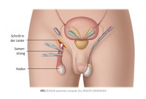 Abb. 1: Orchiektomie – Einschnitt in der Leiste.