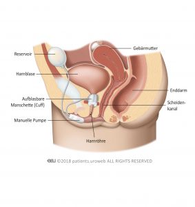 Abb. 1: Implantation eines künstlichen Schließmuskels im unteren Harntrakt der Frau.