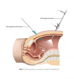 Abb. 2: Bei der laparoskopischen Operation führt der Chirurg seine Instrumente durch kleine Einschnitte in der Bauchdecke ein.