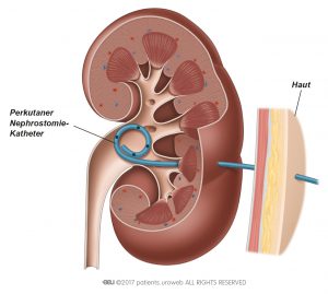 Abb. 2b: Ein perkutaner Nephrostomie-Katheter (Nierenfistel) in der Niere.
