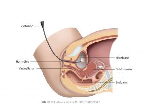 Abb. 2: Urethrozystoskopie.
