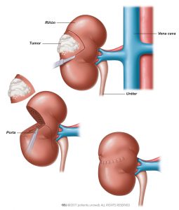 Fig. 1: En la nefrectomía parcial el tumor es resecado, dejando la mayor cantidad de riñón sano posible.