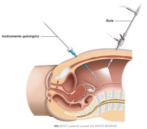 Fig. 3: En la cirugía laparoscópica, el cirujano introduce los instrumentos quirúrgicos a traves de pequeñas incisiones en el abdomen.