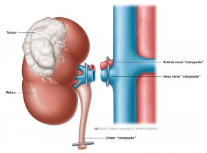 Fig. 1: El tumor es resecado junto con la totalidad del riñón.