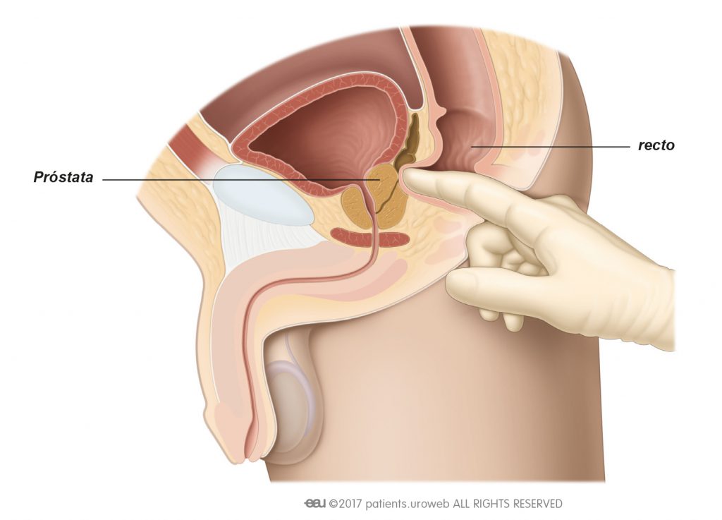 tacto rectal próstata dureri inghinale la bărbați prostatita