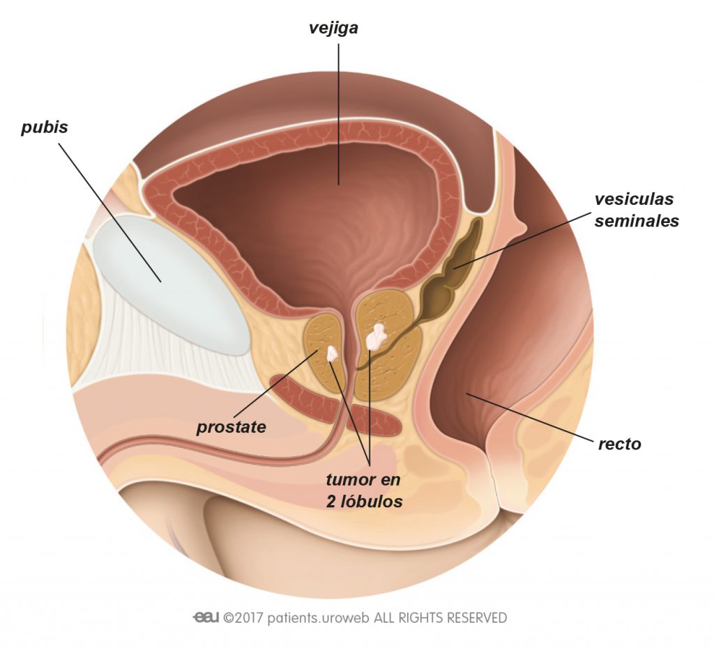 sintomas de cancer de prostata etapa 2)