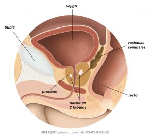Fig. 2: Un tumor prostático T2 está limitado a la próstata.