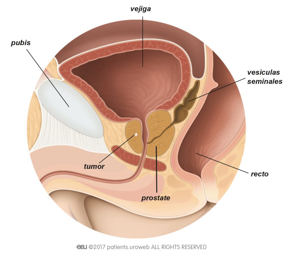 cancer de prostata tumor benigno