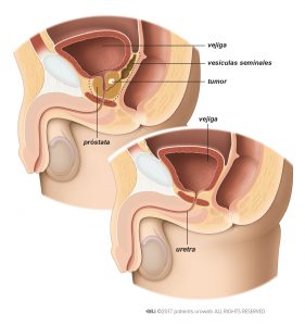 Fig. 1: Durante la prostatectomía radical el cirujano extirpa la próstata completa y las vesículas seminales.