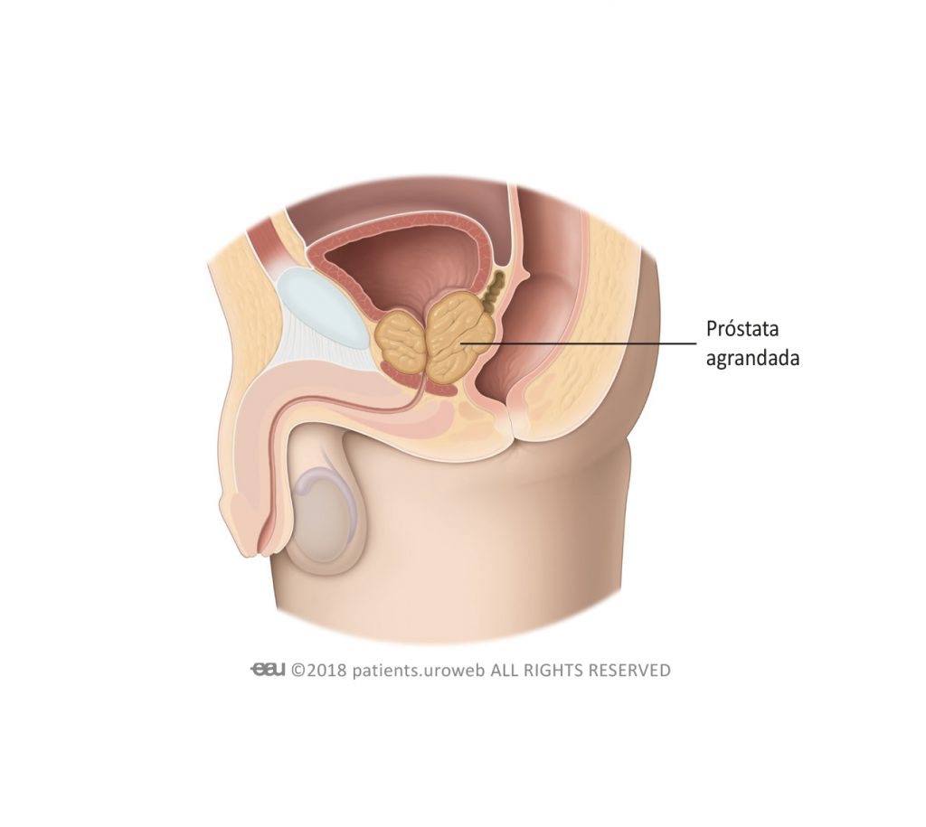 Fig. 1b: Próstata agrandada oprimiendo la uretra y la vejiga.