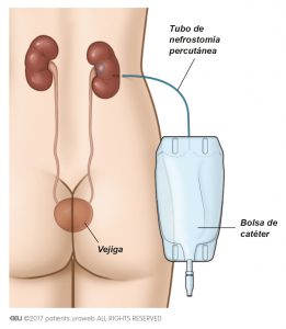 Fig. 2a: Se utiliza un tubo de nefrostomía percutánea para drenar la orina directamente desde el riñón a la bolsa de catéter.