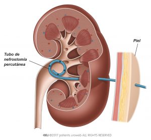 Fig. 2b: Un tubo de nefrostomía percutánea dentro del riñón.