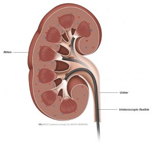 Fig. 2: Un ureteroscopio flexible le permite a su médico llegar prácticamente a cualquier punto dentro del riñón.