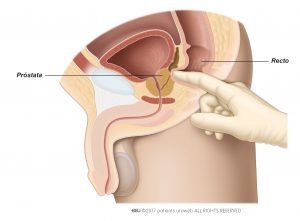 Fig. 1 : El tacto rectal para evaluar el tamaño, la forma y la consistencia de la próstata.