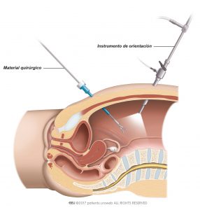Fig. 2: Para la cirugía laparoscópica el cirujano introduce los instrumentos a través de unas pequeñas incisiones en el abdomen.