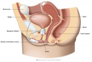 Fig. 1: Colocación de un AUS en el tracto urinario inferior femenino.