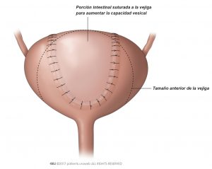 Fig. 4: cirugía vesical para aumentar la capacidad de la vejiga.