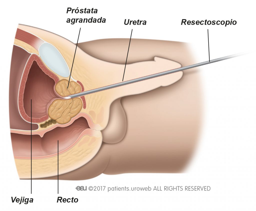 Fig. 1: Cirugía transuretral.