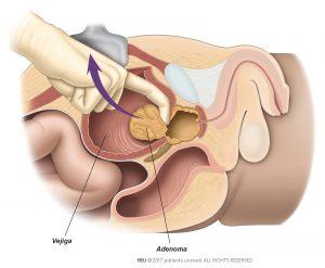 Fig. 1: Cirujano extirpando un adenoma durante prostatectomía abierta.