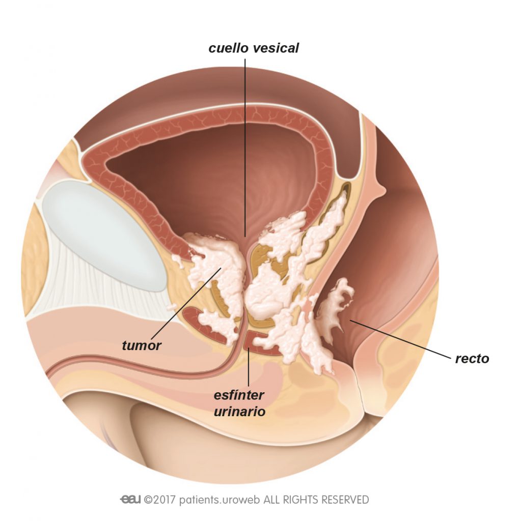 Cancer de prostata avancado tem cura Cancer de prostată: simptome şi diagnostic