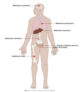 Fig. 1: El cáncer de próstata metastásico se puede extender hacia los huesos, la columna vertebral, los pulmones o el cerebro.