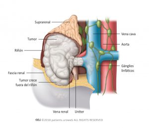 Fig. 1: Tumores estadio III han invadido ya la vena renal, el tejido graso peri-renal o la vena cava.