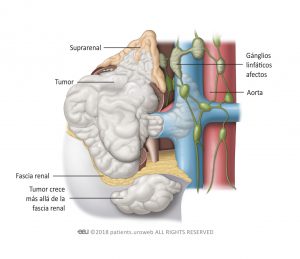 Fig. 2: Tumores estadio IV se han extendido más allá de la fascia renal y/o la suprarenal. A veces, uno o más gánglios aparecen afectos en estos casos.