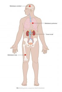 Fig. 5: Cáncer renal metastásico puede diseminarse a los pulmones, huesos o el cerebro.