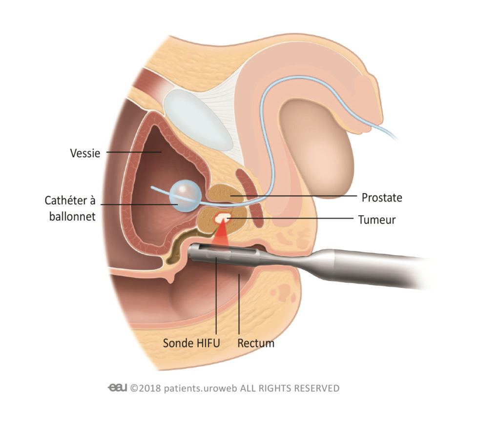 prostate et gaz intestinaux