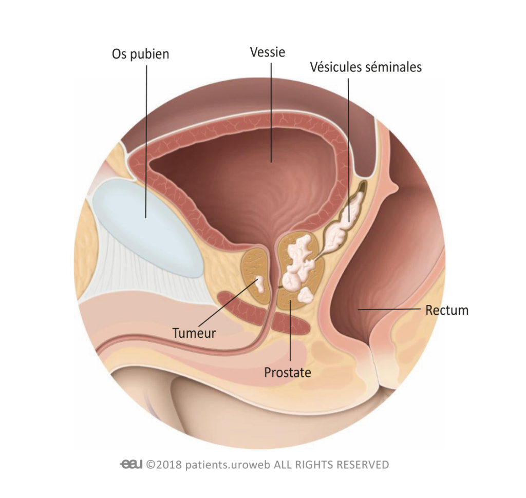 cancer de la prostate stade 5