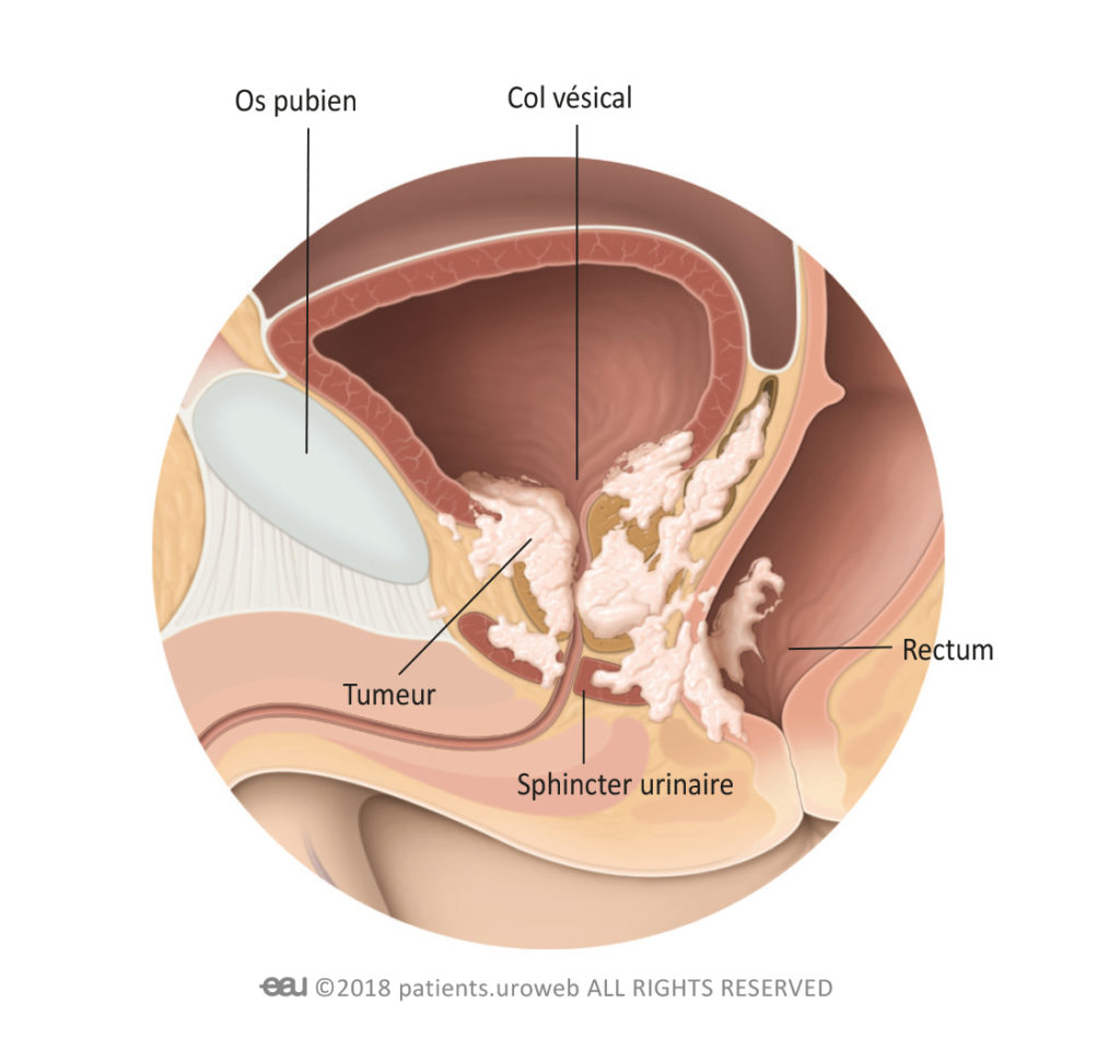cancer prostate symptômes phase terminale
