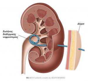 Εικ. 2b: Σωλήνας διαδερμικής νεφροστομίας εντός του νεφρού.