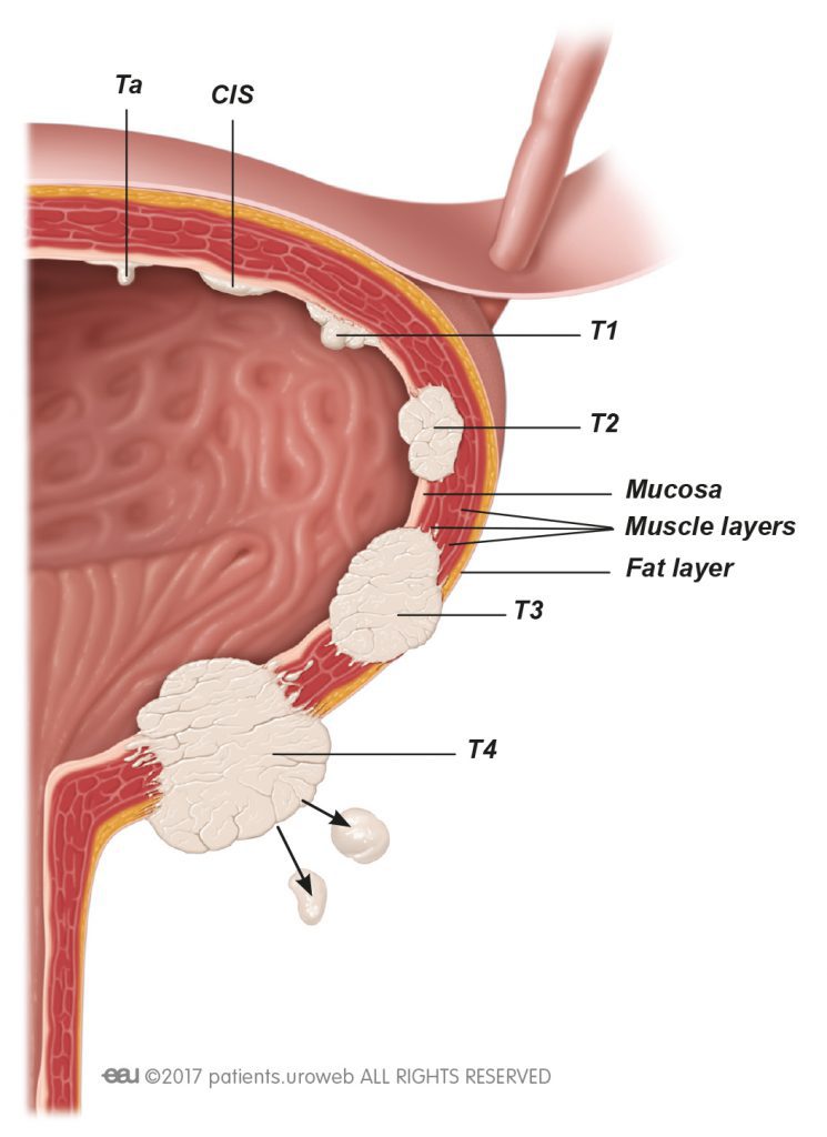 Εικόνα 3. Ταξινόμηση σύμφωνα με το στάδιο του όγκου.
