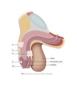 Εικόνα 1: Στάδια του καρκίνου του πέους