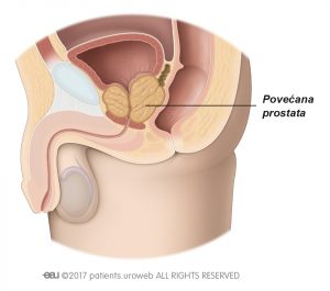 Slika 2: Povećana prostata pritišće mokraćnu cijev i mokraćni mjehur.