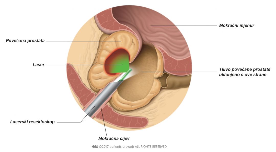 Slika 2: Toplina iz lasera topi djeliće tkiva prostate.