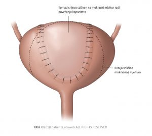 Slika 2: Operacija mokraćnog mjehura kako bi se povećao kapacitet mokraćnog mjehura