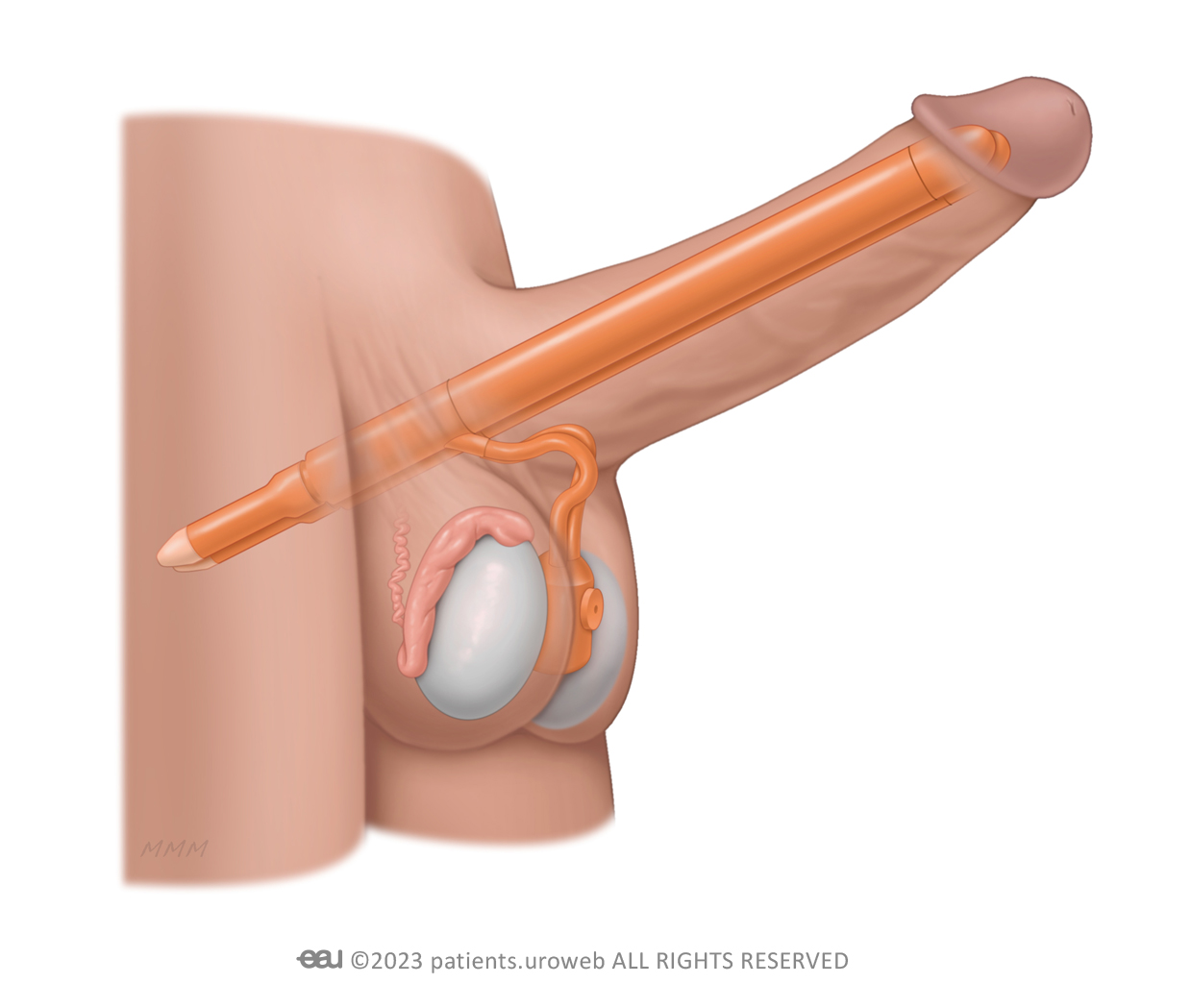 ED-Penile-implant.jpg