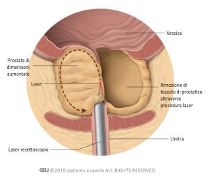 Fig. 2: Il laser taglia parti del tessuto prostatico durante l'enucleazione.