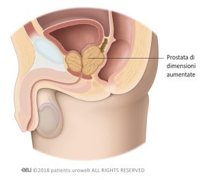 Fig.2: Prostata di dimensioni aumentate ostruente uretra e vescica.