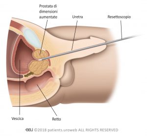 Fig.1: Chirurgia trans uretrale.