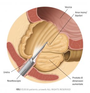 Fig.2: Il resettoscopio rimuove parte del tessuto prostatico durante la TURP.
