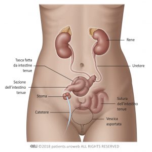 Fig. 4: Diversione urinaria cutanea.