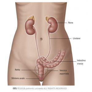 Fig. 5: Diversione uretero colica.