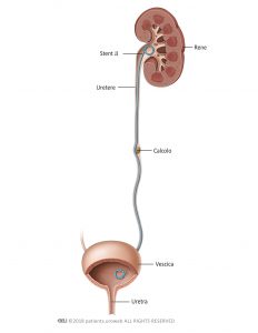 Fig. 1: Uno stent JJ viene inserito per consentire lo scorrimento di urina nel tratto urinario.