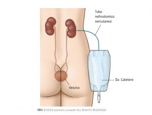 Fig 2: La nefrostomia percutanea viene utilizzata per raccoglier le urine dal rene direttamente all’interno di una sacca.